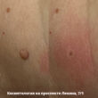Удаление новообразований кожи (сразу после)_доктор Воробьева В.А.