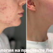 Лечение-акне_доктор-Воробьева-В.А.